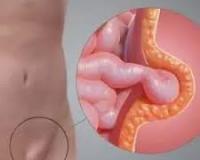 Чем фуникулоцеле отличается от гидроцеле и паховой грыжи